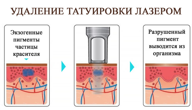 Лазерное удаление татуировок в Казани по цене от рублей